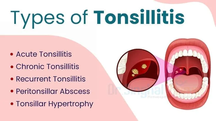 Class Frequency Tonsilitis