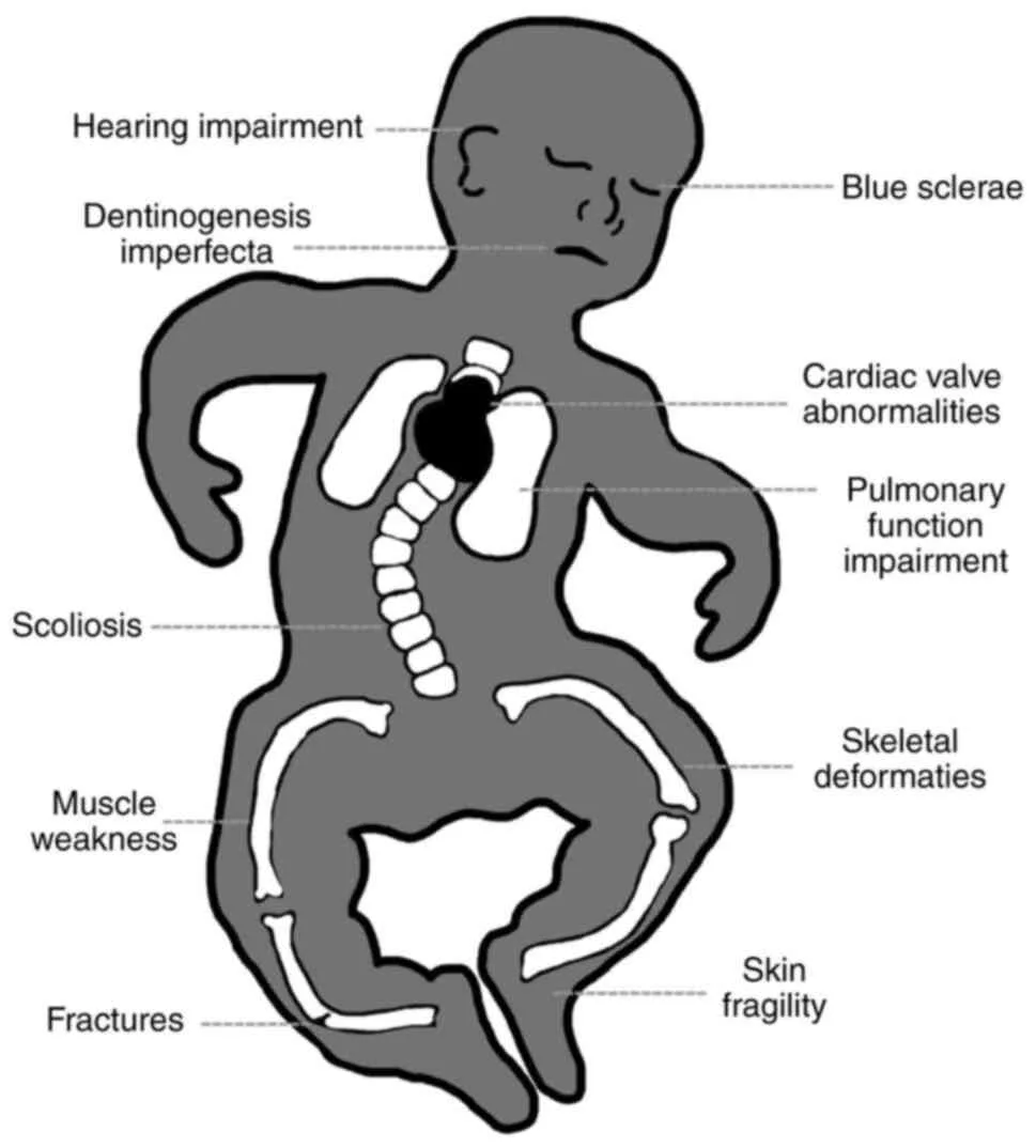 Clinical Manifestations Of Osteogenesis Imperfecta