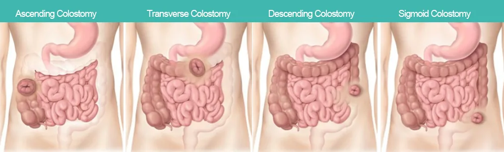 Colostomy Types