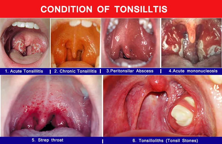 Conditions With Tonsilitis