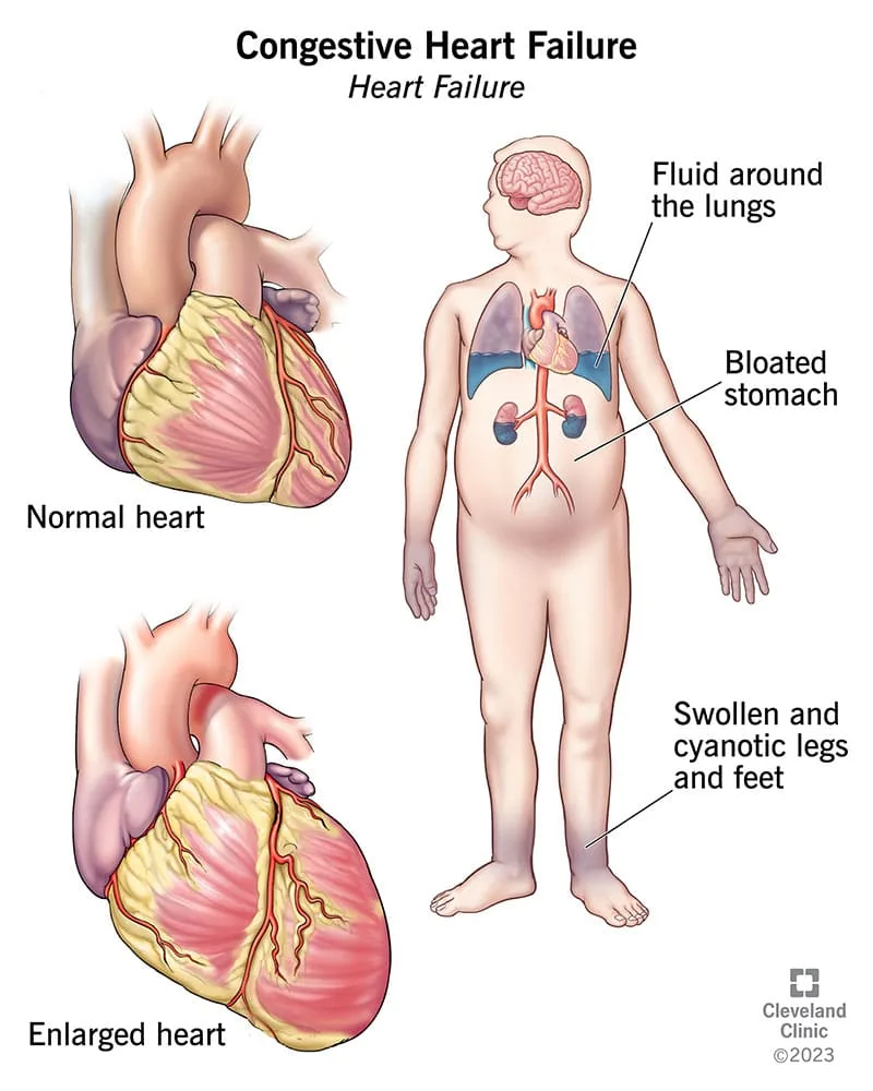 Congestive Heart Failure 1