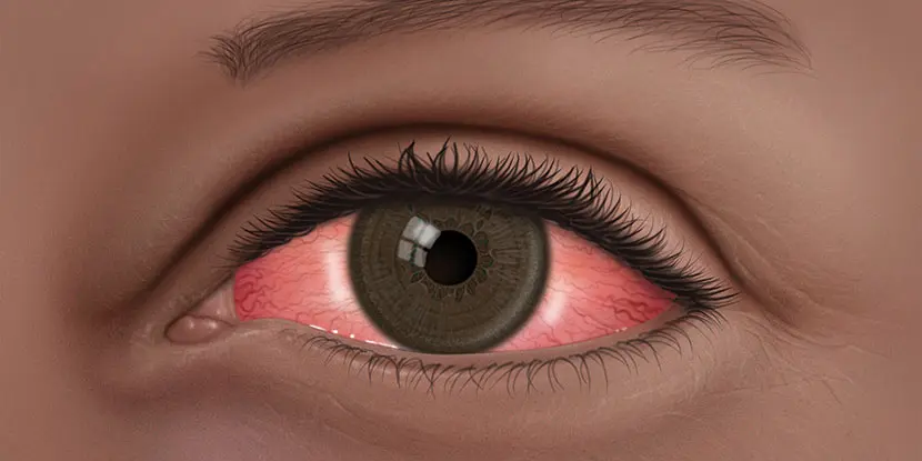 Conjuuctivitis