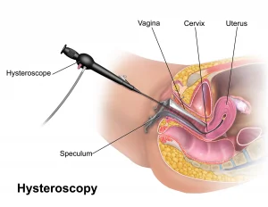 Dx Of Menorrhagia