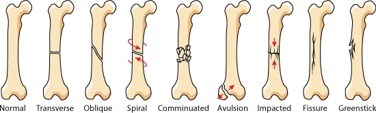 Fractures