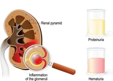 Glomerulonephritis 1