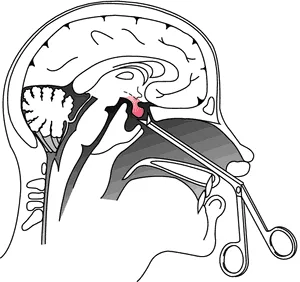 Hypophysectomy 1