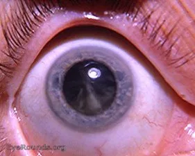 Immature Senile Cortical Cataract OD