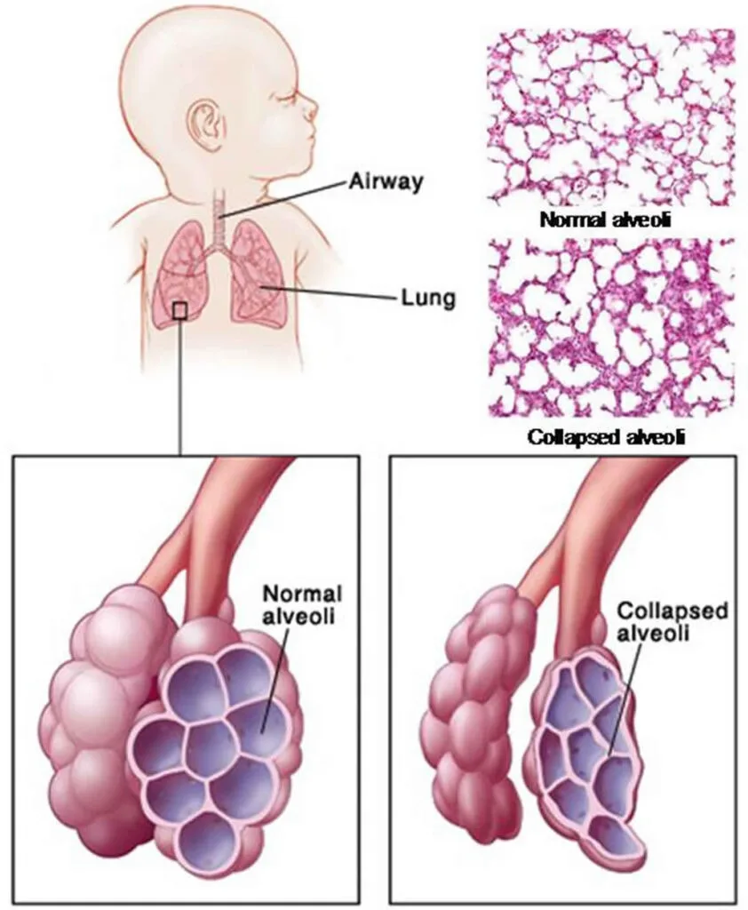 Infant Respiratory Distress Syndrome