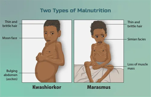 Kwashiokor Marasmus 1