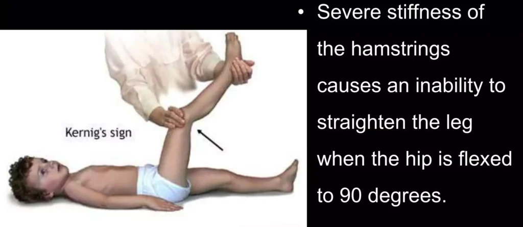 Meningitis Kernings Sign E1702982517956