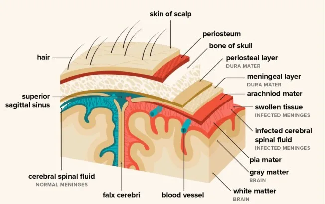 Meningitis Meninges