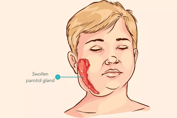 Mumps Parotitis