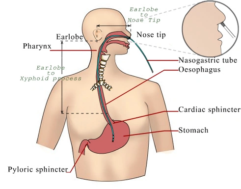 Nasogastric Tube1