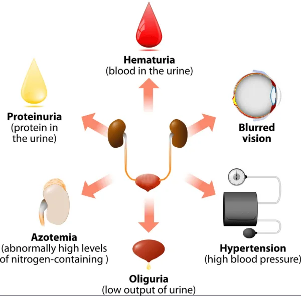 Nephritic Syndrome Signs And Symptoms E1703589662733