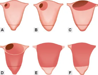 Normal Fundal Dominance