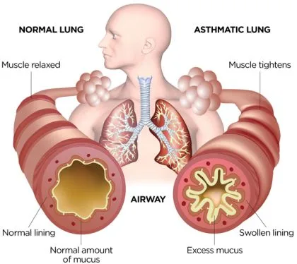 Normal Vs Asthma Lung