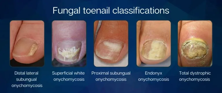 Onychomycosis Classifications