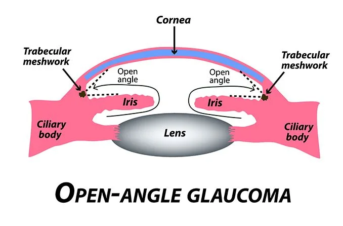 Open Angle GLAUCOMA