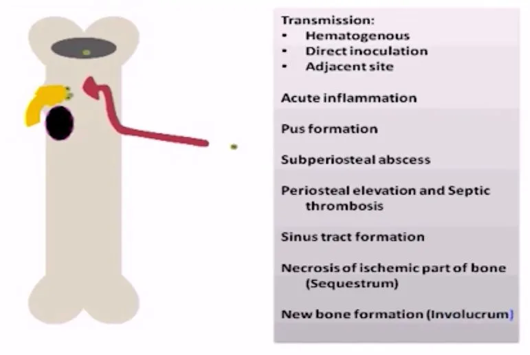 Osteomyelitis Pathogenesis