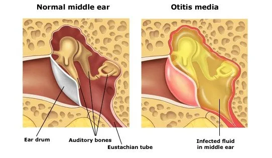Otitis Media