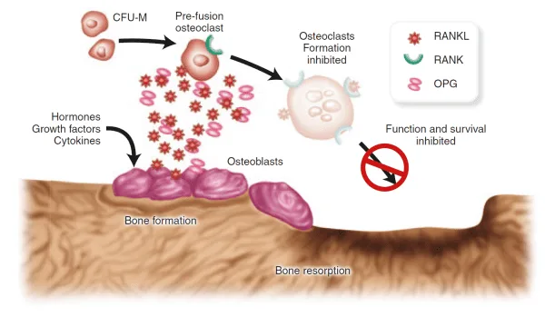 Pathophysiology Osteoporosis 1
