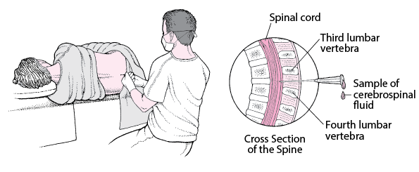 Perform Lumbar Puncture