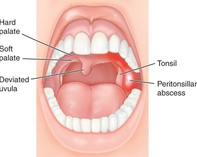 Peritonsillar