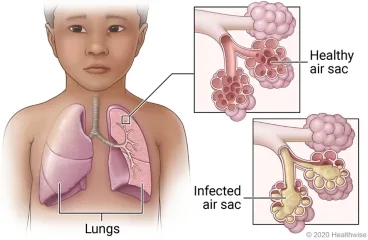 Pneumonia In Children