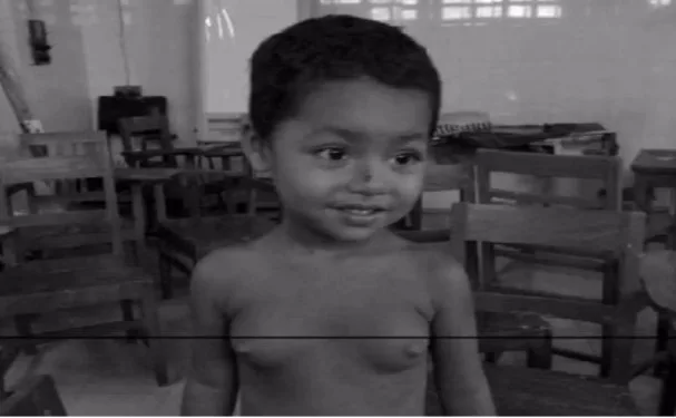 Precocious Puberty