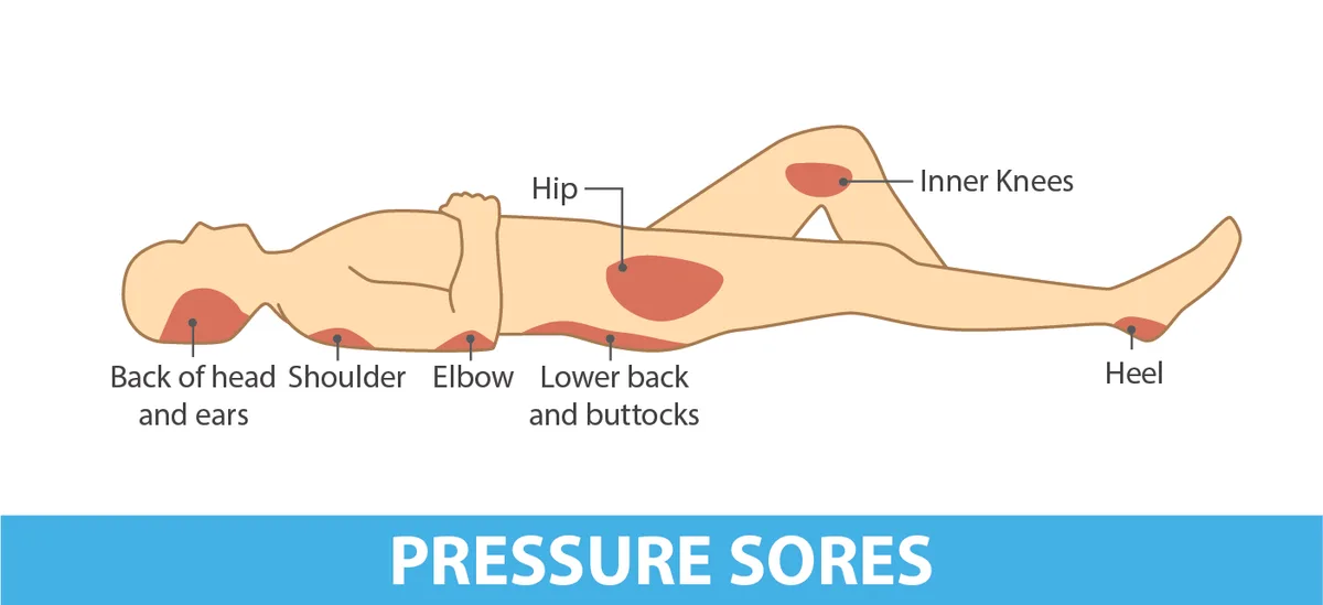 Pressure Sore Areas English