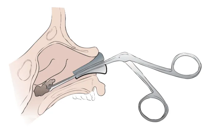 Removal Technique Foreign Body From The Nose 1