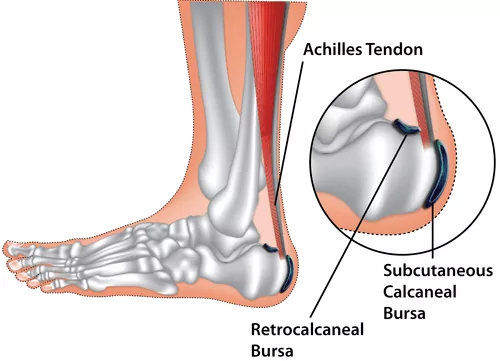 Retrocalcaneal Bursitis
