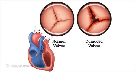 Rheumatic Heart Disease