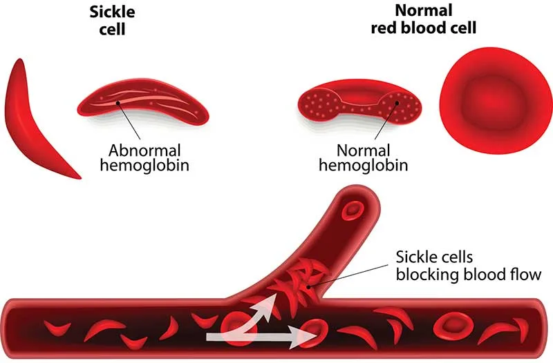 Sickle Cell Sickle Cell Disease