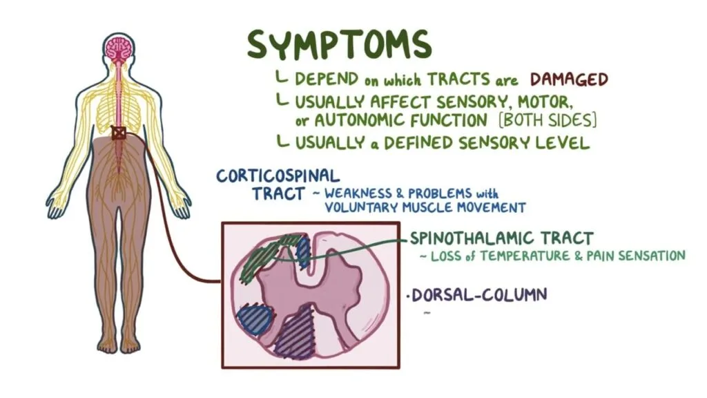 Signs And Symptoms Of Transverse Myelitis 1