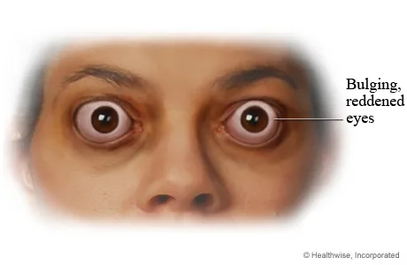Signs Of Proptosis