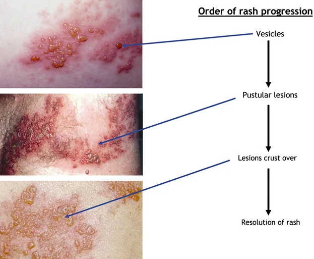 Stages Herpes 1