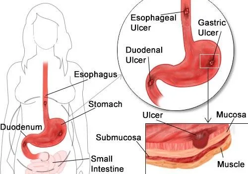 Stomach Vs Duodenal