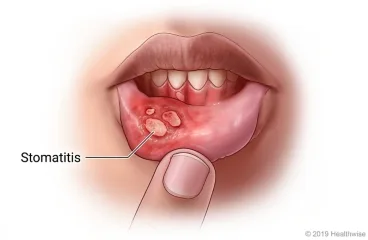 Stomatitis