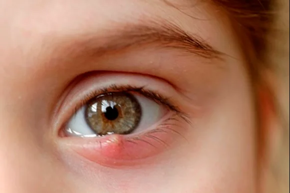 Stye Stye