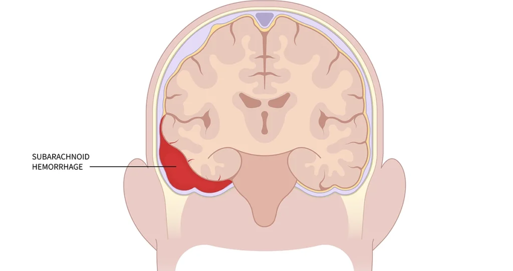 Subarachnoid E1742829818249