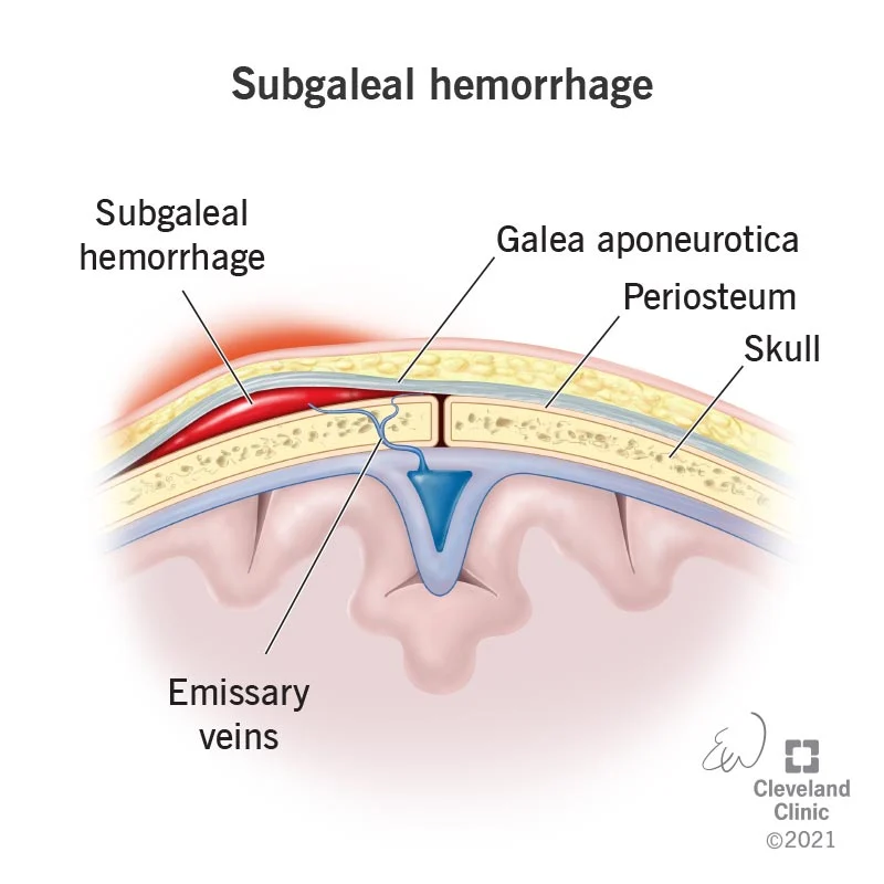 Subgaleal Hemorrhage