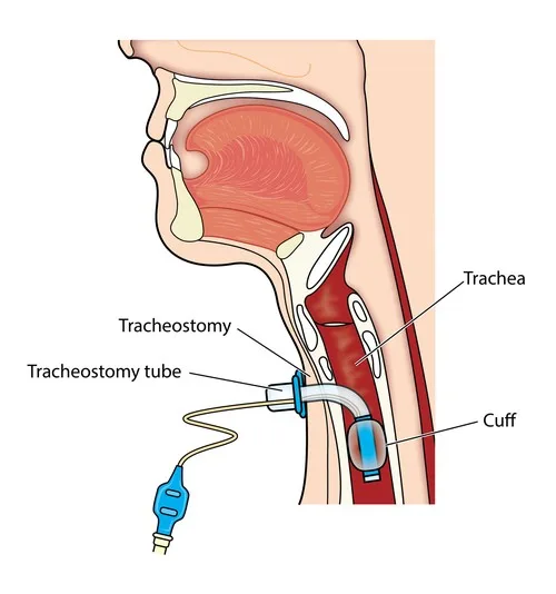 Tracheostomy Care