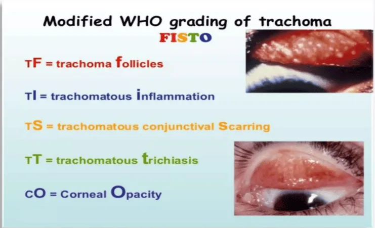 Trachoma Staging 1