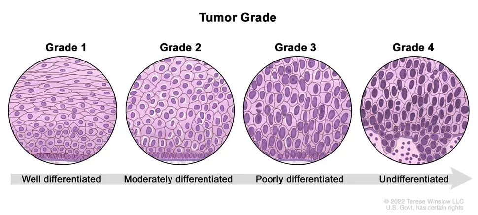 Tumor Grade