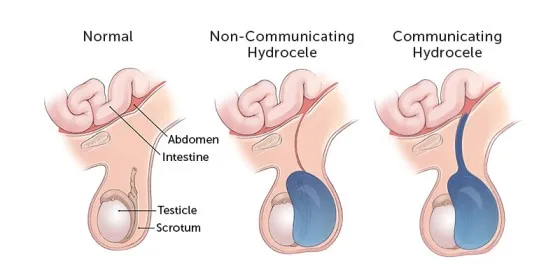 Types Of Hydrocele