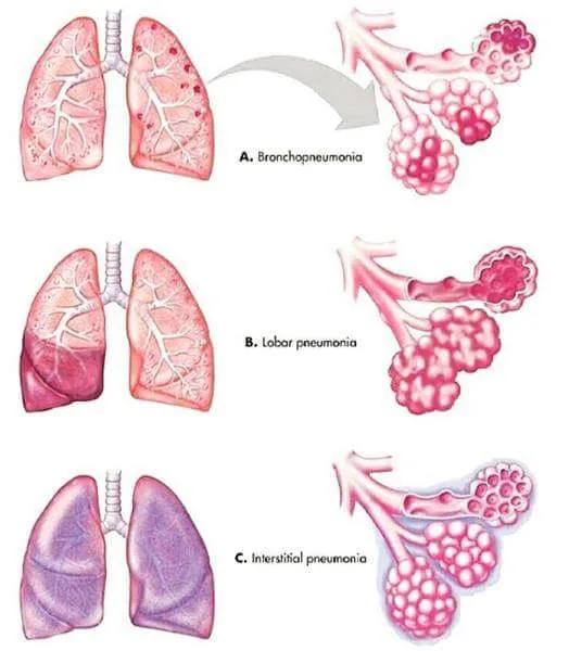 Types Of Pneumonia